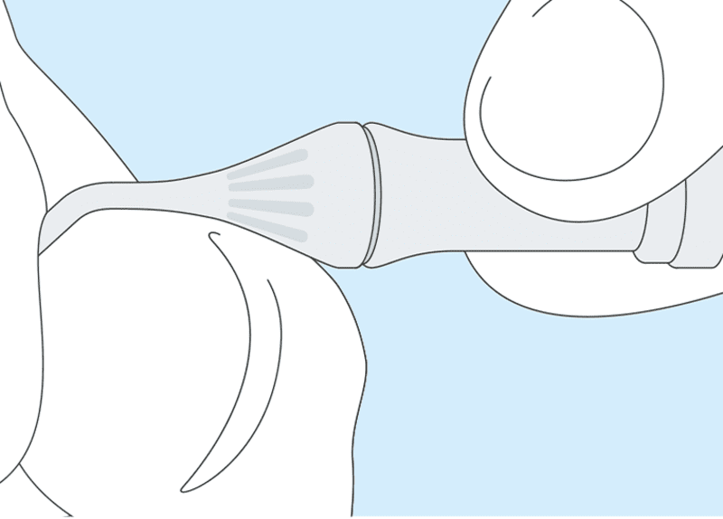 Retrakcijska pasta 25 x 0,37g – DMG - Slika 2