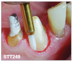 Instrumenti za liječenje gingive STT249 - Edenta - Slika 2
