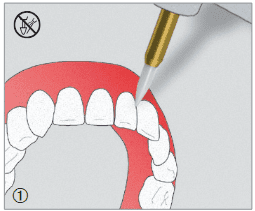 Instrumenti za liječenje gingive STT249 - Edenta - Slika 3