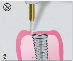 Instrumenti za liječenje gingive STT249 - Edenta - Slika 4