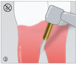 Instrumenti za liječenje gingive STT249 - Edenta - Slika 5